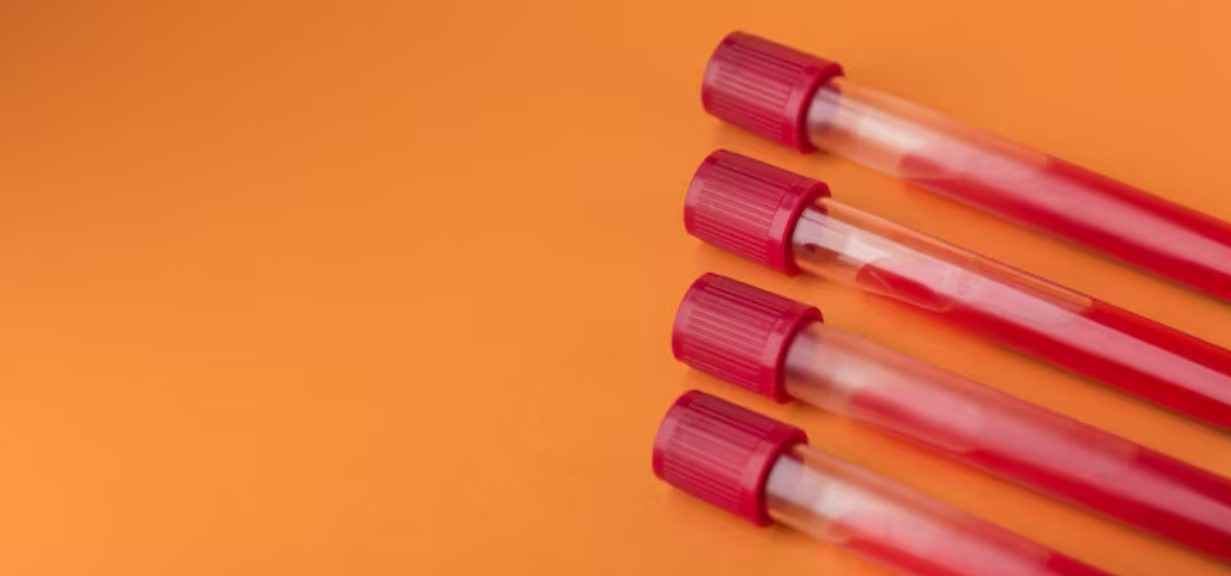 Read more about the article IgG 검사 – 정상 수치, 높을 때 낮을 때 원인, 식사 방법 및 면역 기능 평가