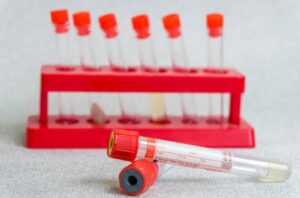 Read more about the article Haptoglobin 검사 정상 수치, 높을 때 낮을 때 원인, 식사 방법 및 용혈 진단