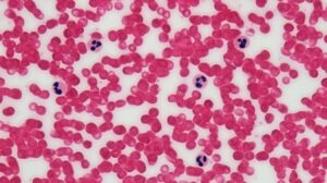 Read more about the article Eosinophil(호산구) 수치 가이드 정상 범위와 호산구 증가증의 원인
