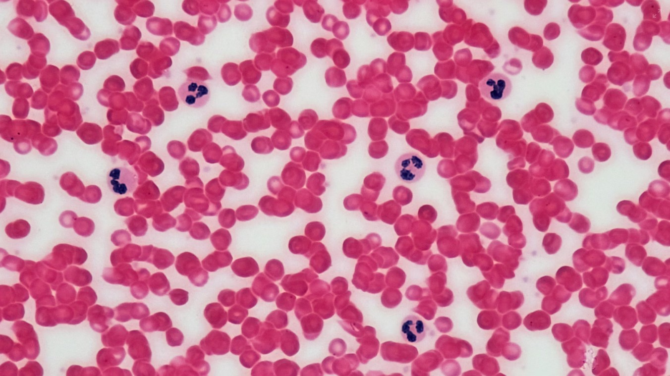 Read more about the article Eosinophil(호산구) 수치 가이드 정상 범위와 호산구 증가증의 원인