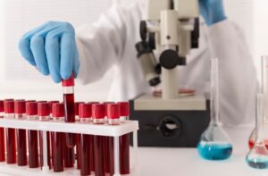 Read more about the article Lupus Anticoagulant(LA) 검사 수치 해석과 항인지질항체 증후군 진단