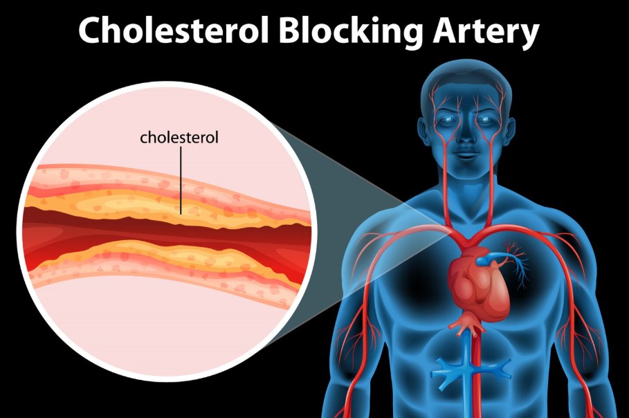 Read more about the article 성인병 고지혈증(이상지질혈증) 리포트: 콜레스테롤 수치 관리법