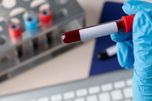 Read more about the article Cortisol(코르티솔) 스트레스 호르몬 정상범위와 부신 질환 판독