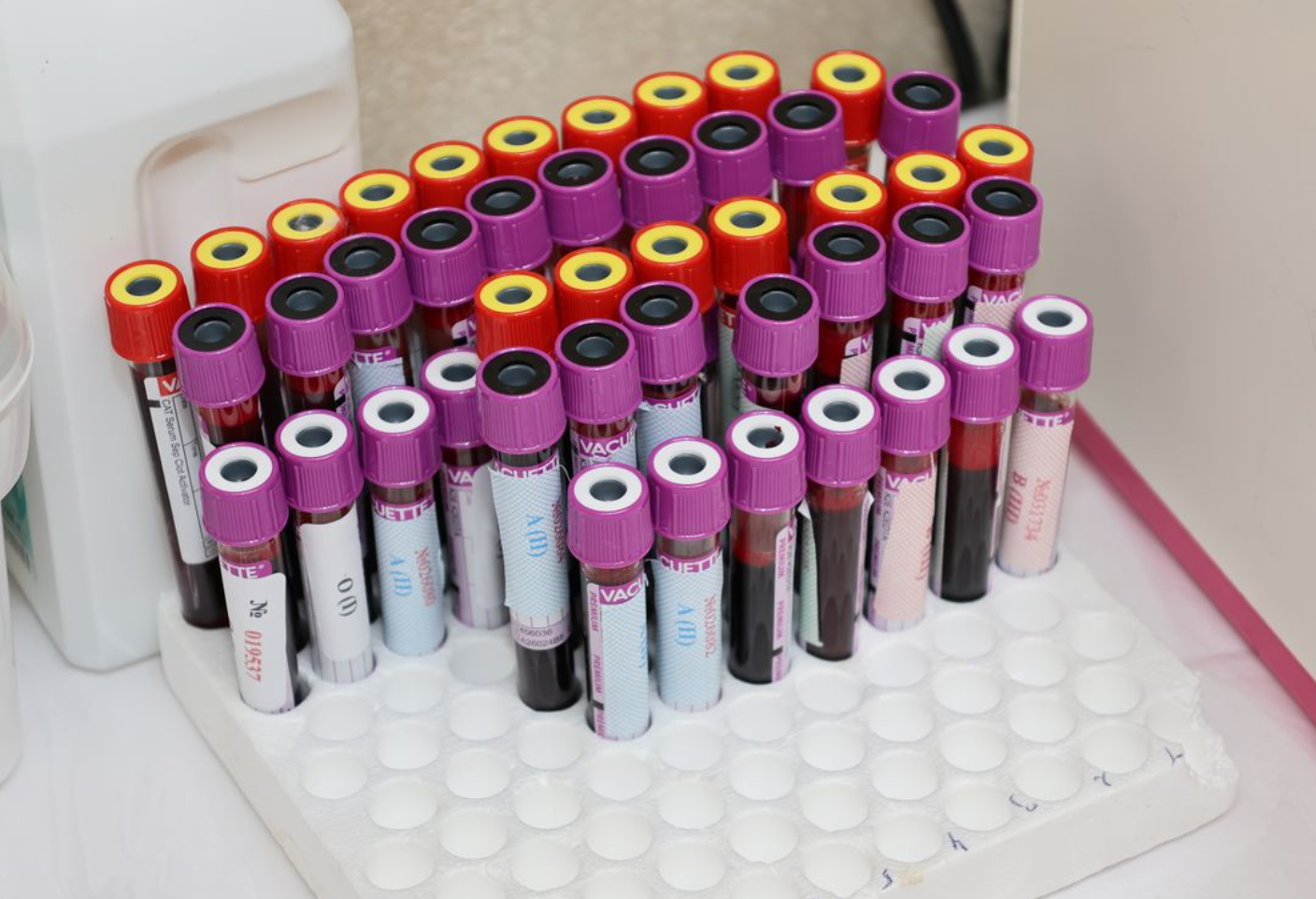 Read more about the article Ab Identification(비예기항체 동정검사) 수혈 오류와 용혈성 부작용을 막는 최종 방어선