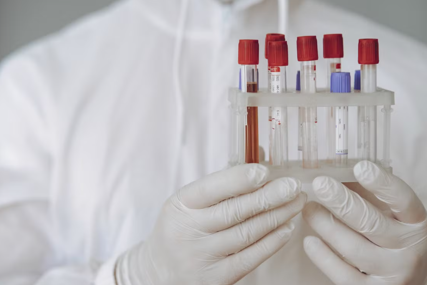 Read more about the article Ketone body (케톤체) 3분획 검사 케토아시도시스(DKA) 및 유기산 대사 정밀 진단학적 접근