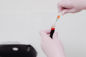 Read more about the article 유구 낭미충(Parasite Ab IgG) 검사 뇌 및 피하조직 기생충 감염의 정밀 진단학적 접근